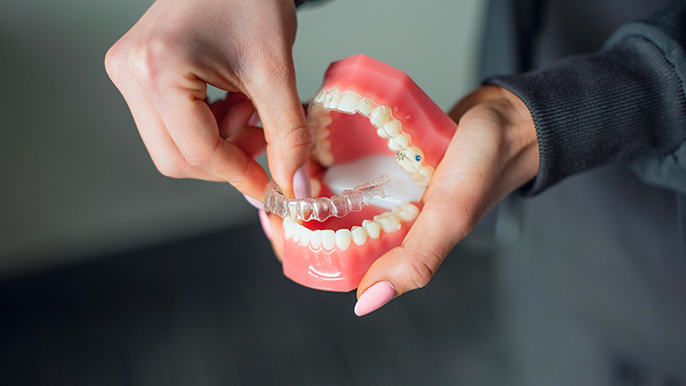 Hands demonstrating a clear Invisalign aligner on a dental model